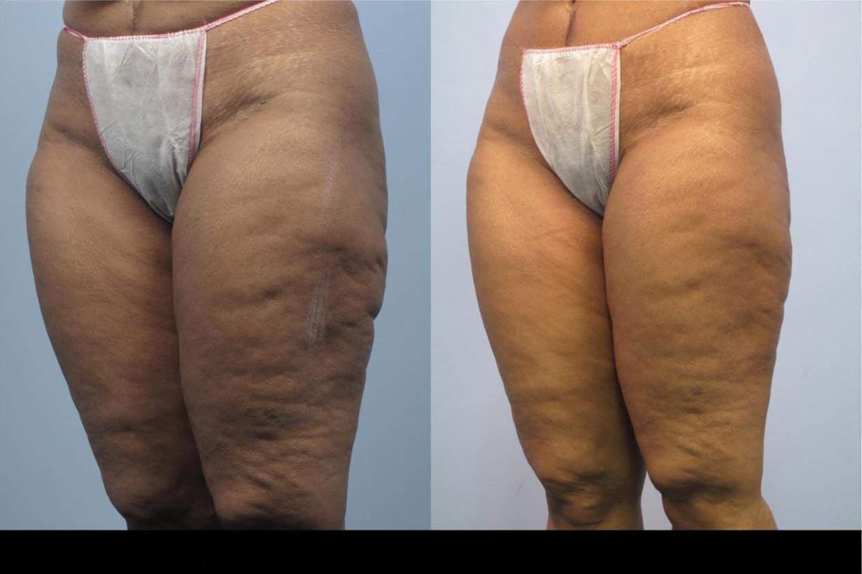 Before and after image of cellulite treatment in Toronto showing smoother skin and reduced dimpling on the thighs.