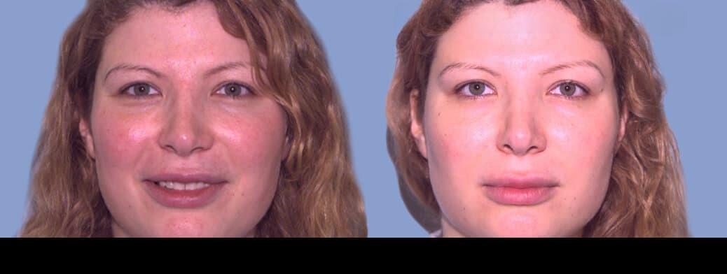 Photo 5 of a Patient Before and After IPL Photofacial Treatment in Toronto.