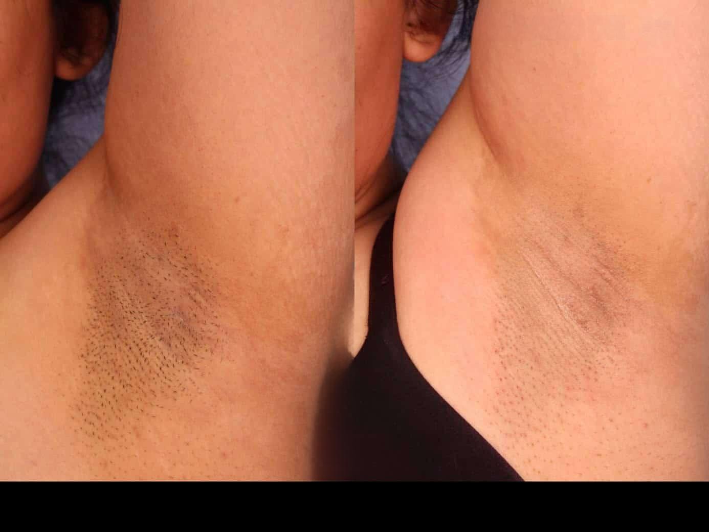 Photo 5 of a Patient Before and After Laser Hair Removal in Toronto.