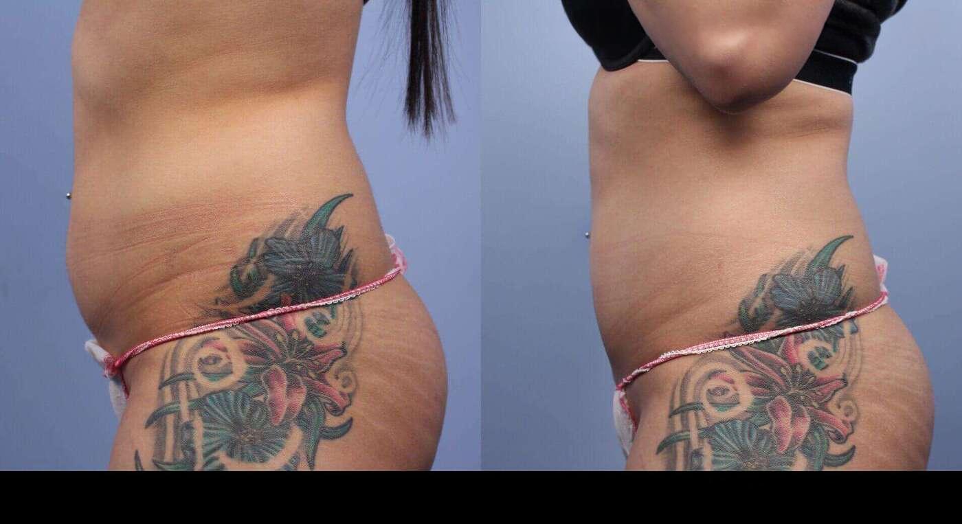 Photo 5 of a Patient Before and After Non-Surgical Body Contouring in Toronto.