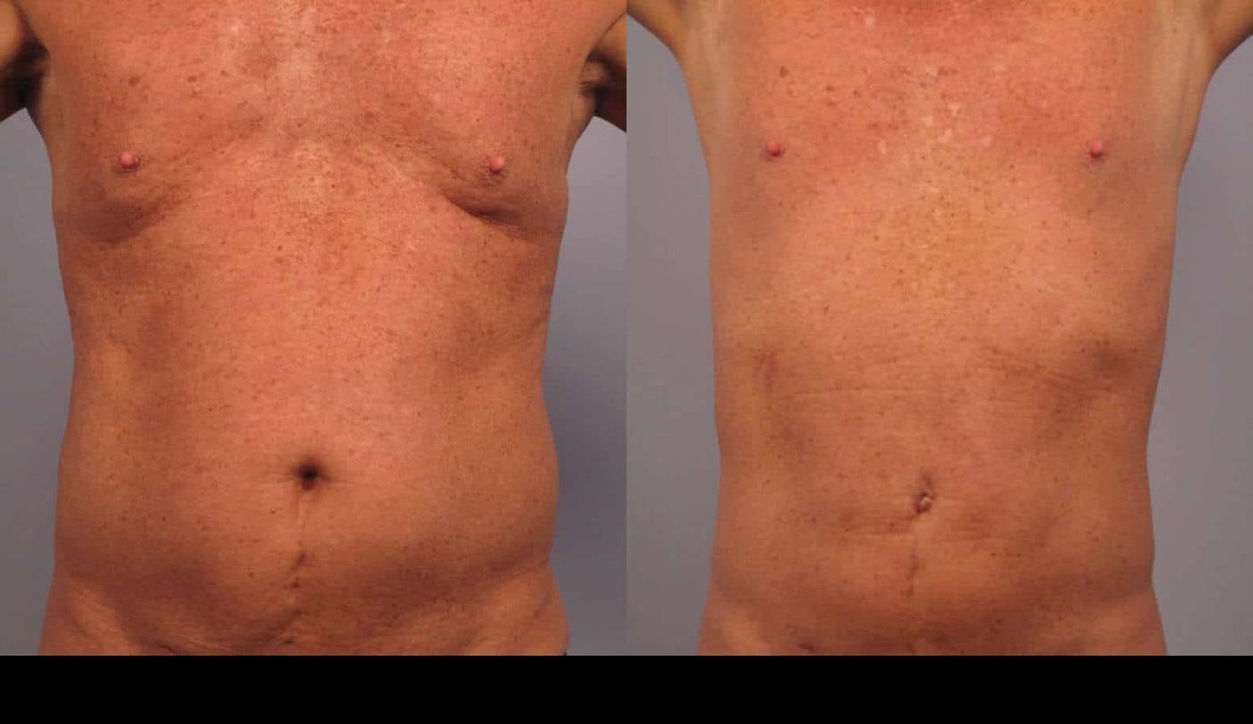 Photo 5 of a Patient Before and After Non-Surgical Liposuction in Toronto.