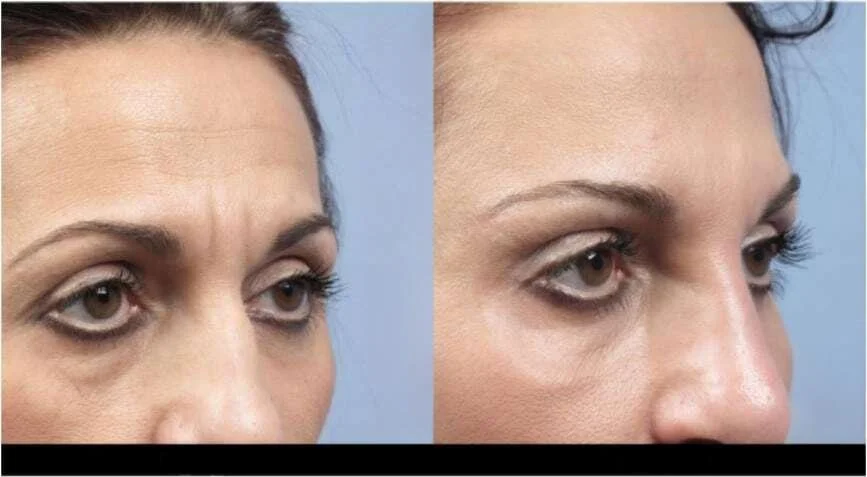 Before and after photo of a patient receiving Botox treatment in Toronto showing softened frown lines.
