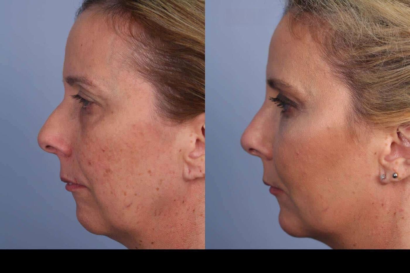 Photo 6 of a Patient Before and After IPL Photofacial Treatment in Toronto.