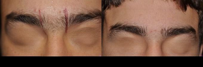 Photo 6 of a Patient Before and After Laser Hair Removal in Toronto.