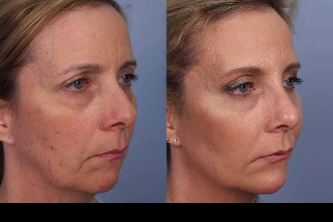 Photo 6 of a Patient Before and After Laser Wrinkle Removal in Toronto.