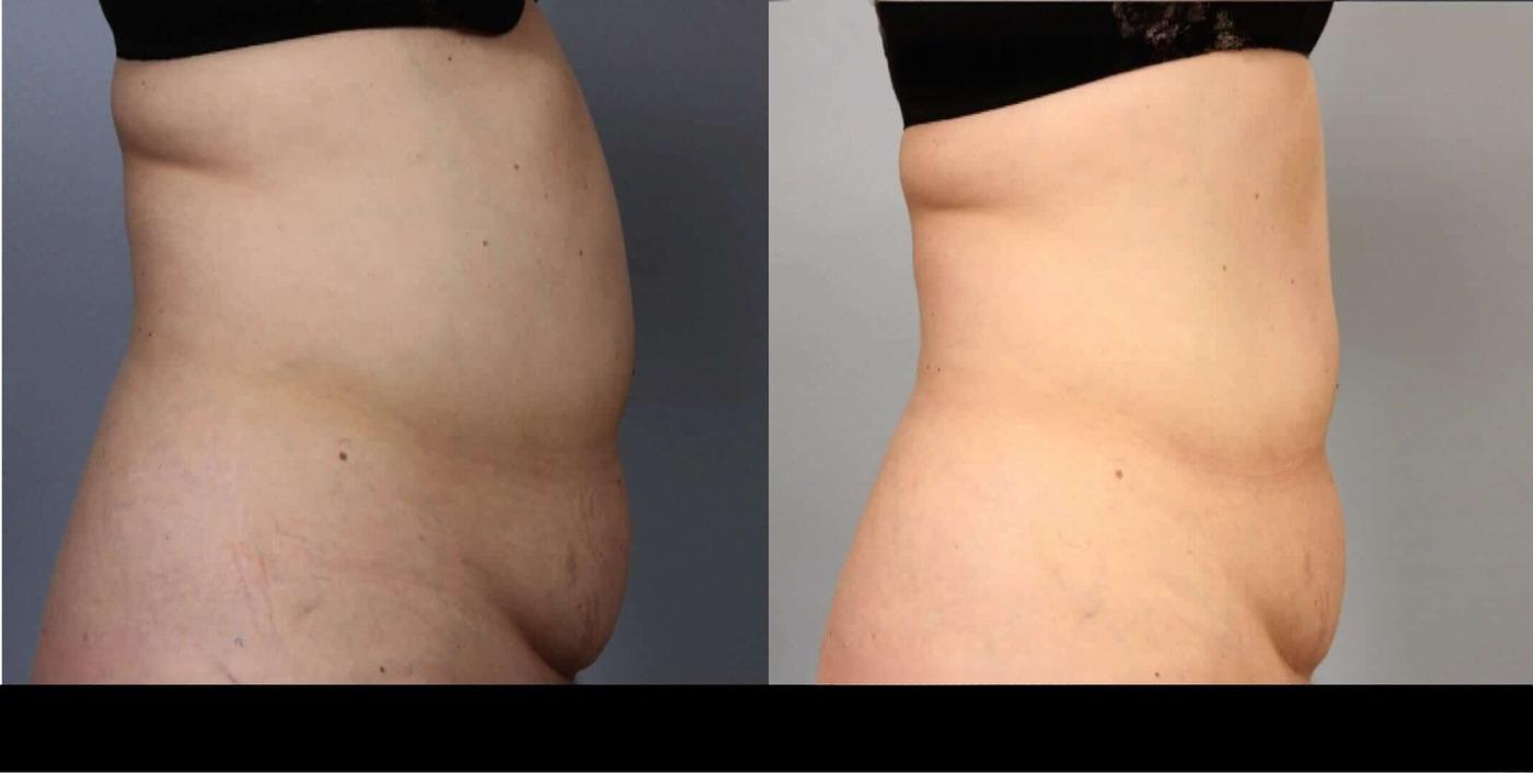 Photo 6 of a Patient Before and After Non-Surgical Body Contouring in Toronto.