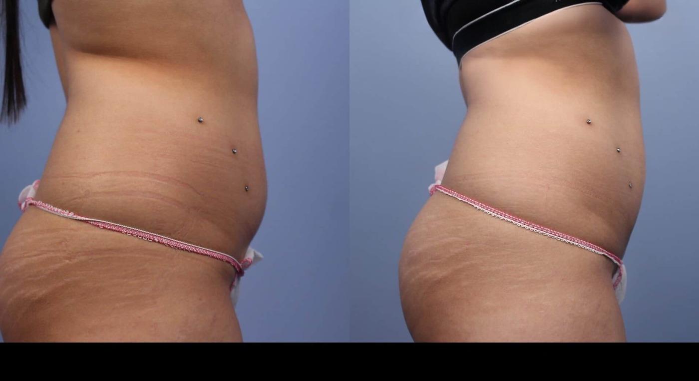 Photo 6 of a Patient Before and After Non-Surgical Liposuction in Toronto.