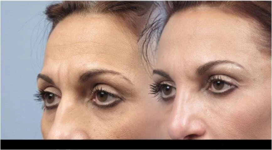 Comparison image of a patient before and after Botox in Toronto highlighting smoother skin and reduced forehead wrinkles.
