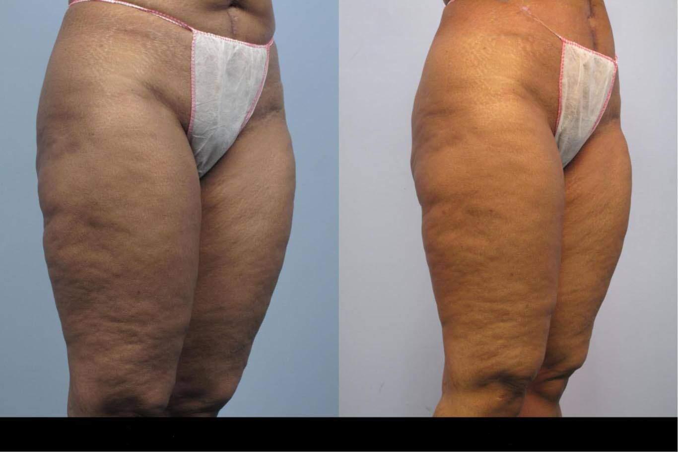Before and after cellulite treatment in Toronto highlighting smoother skin and less visible cellulite on the legs.