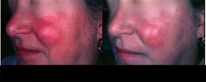 Photo 7 of a Patient Before and After IPL Photofacial Treatment in Toronto.