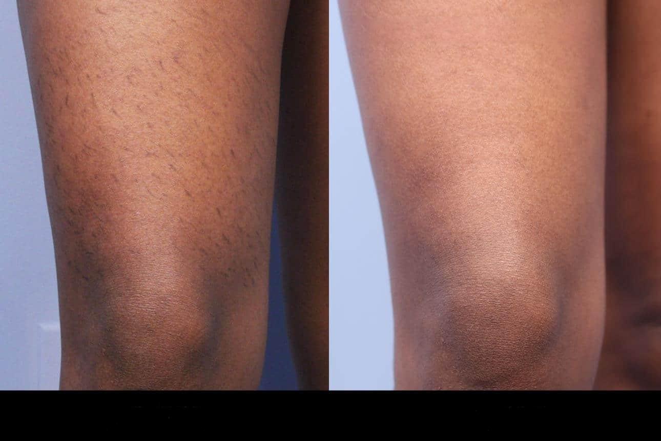 Photo 7 of a Patient Before and After Laser Hair Removal in Toronto.