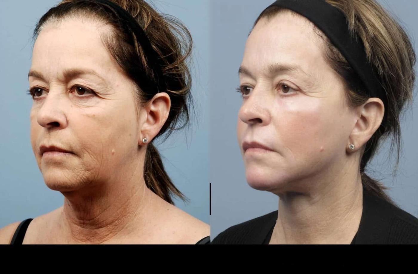 Photo 7 of a Patient Before and After Microdermabrasion in Toronto