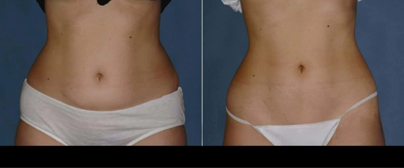 non-surgical procedures for abdomen contours after weight loss glp-1 Sculpt your body. No surgery GLP-1 Makeover Body Contouring: Post