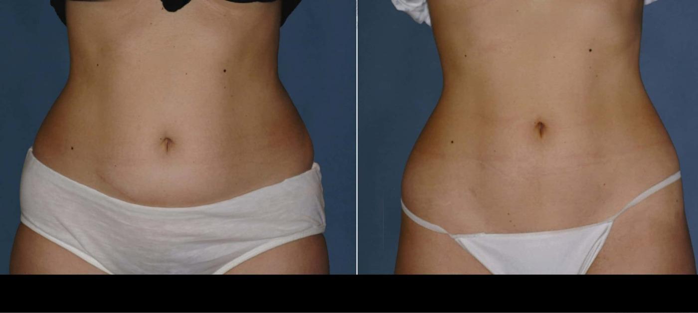 Photo 7 of a Patient Before and After Non-Surgical Liposuction in Toronto.