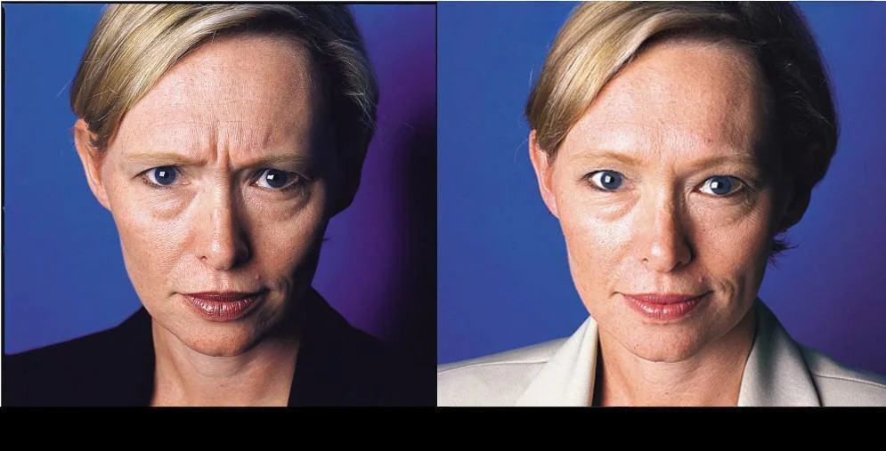 Botox in Toronto before and after image focusing on significant wrinkle reduction in the forehead area.
