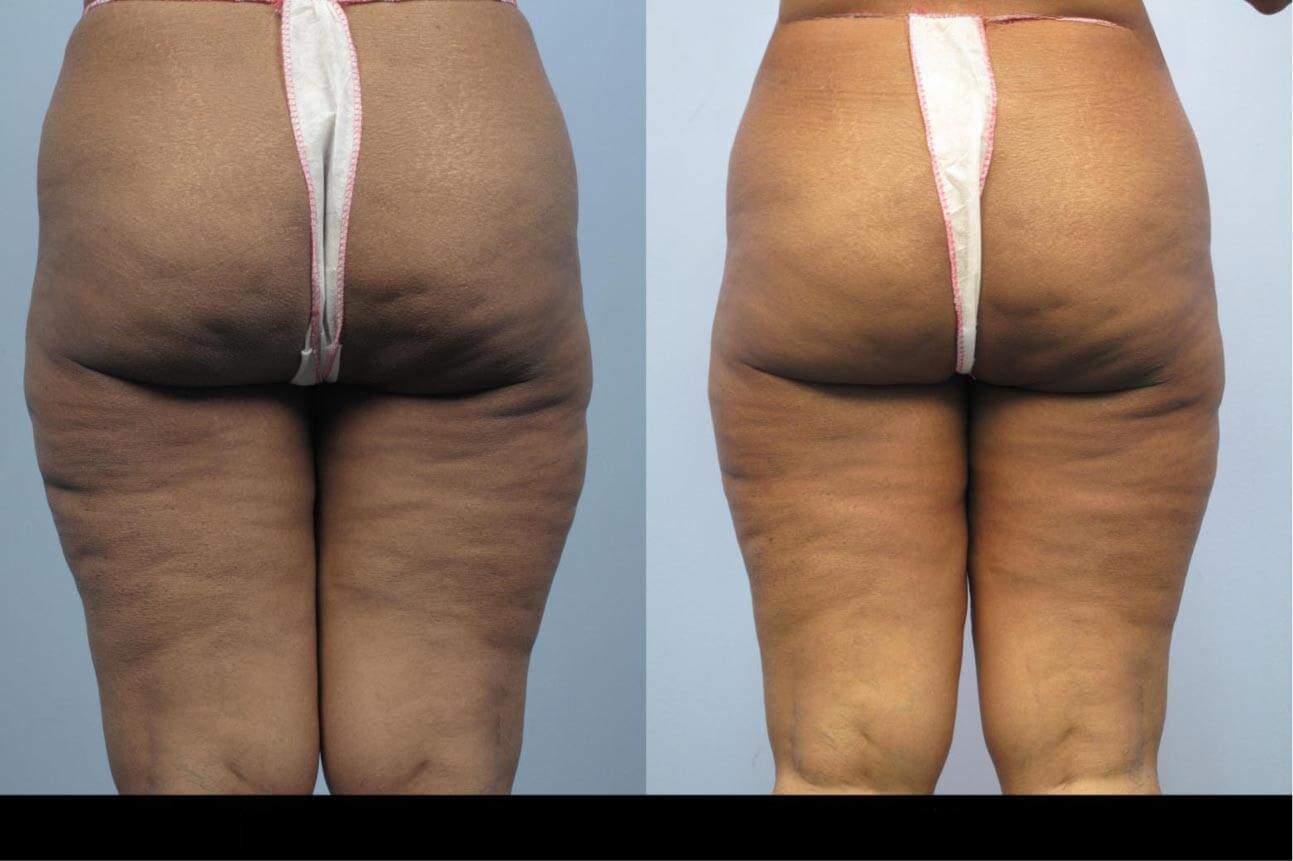 Cellulite removal in Toronto showing noticeable improvement in skin texture and reduced cellulite on the back of the thighs and buttocks.