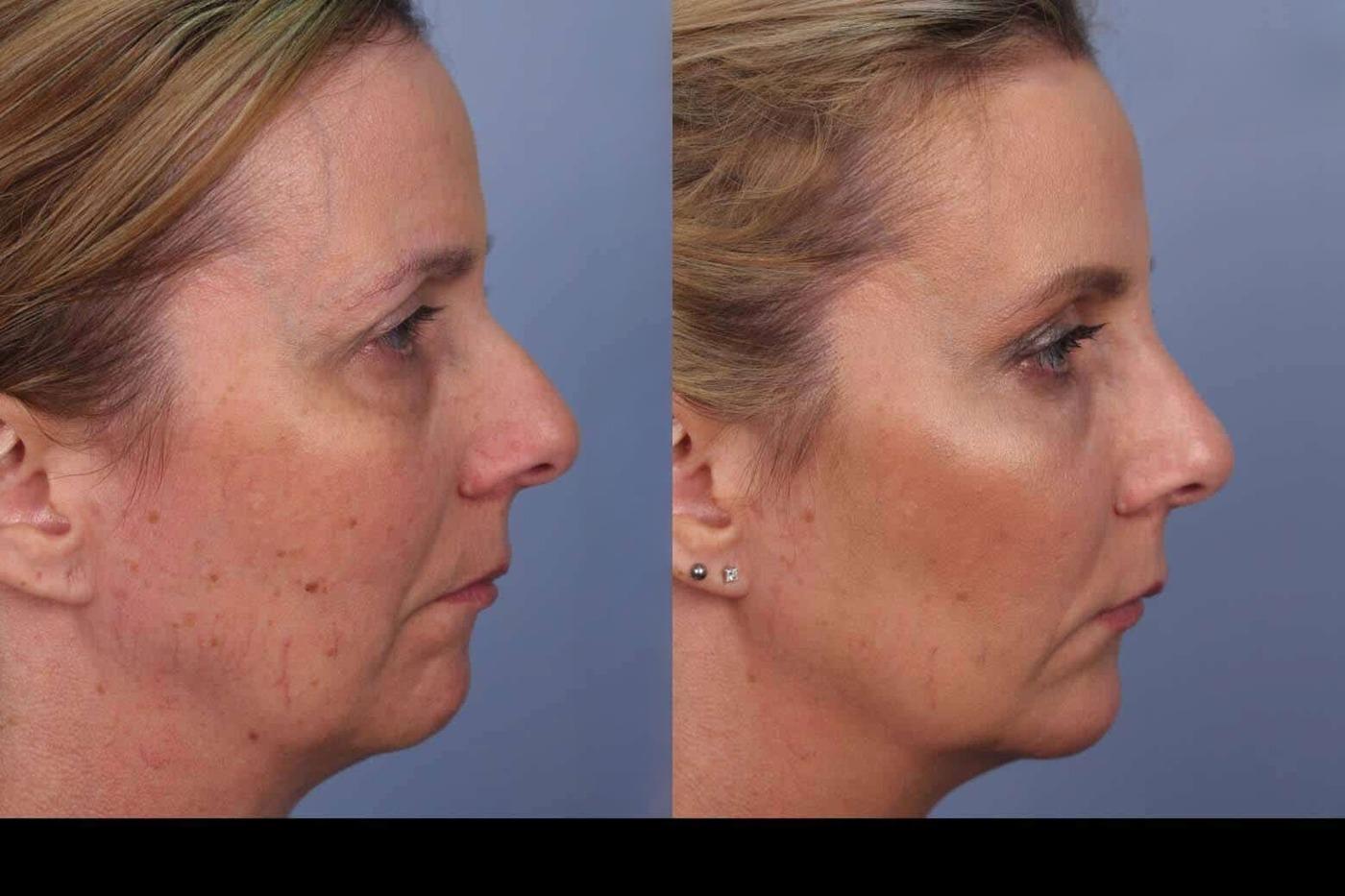 Photo 8 of a Patient Before and After IPL Photofacial Treatment in Toronto.