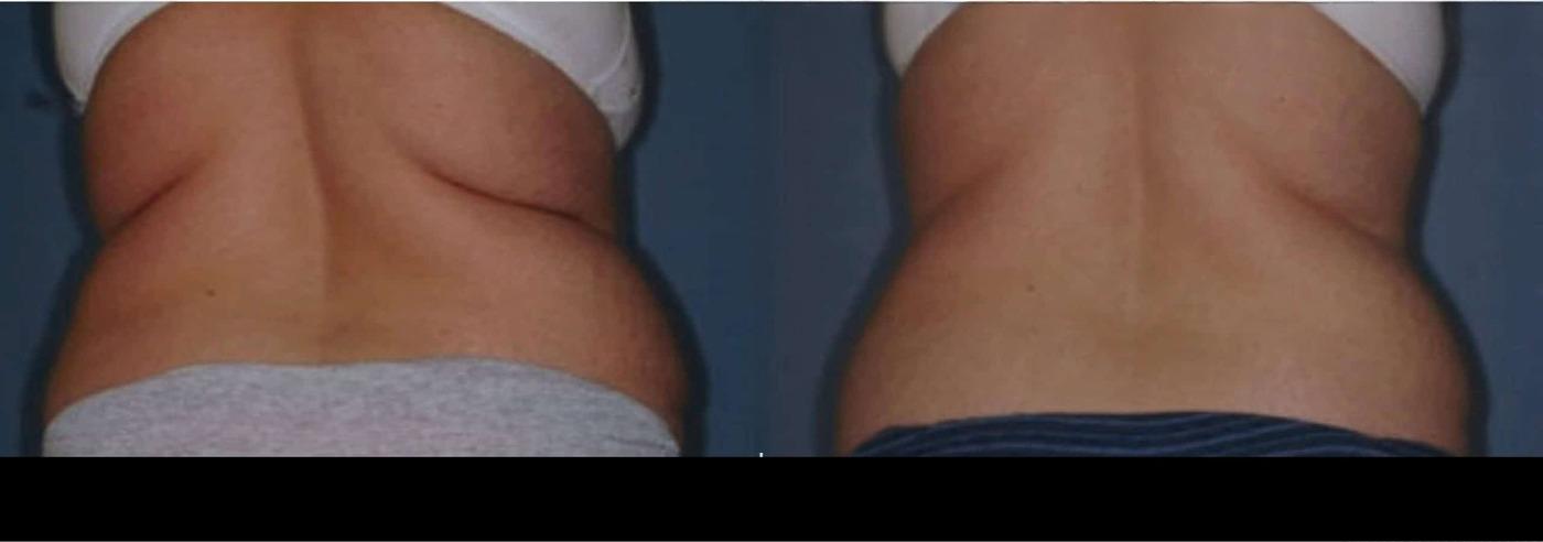 Photo 8 of a Patient Before and After Non-Surgical Body Contouring in Toronto.