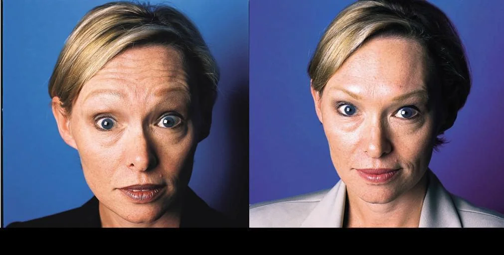 Results of Botox treatment in Toronto showing a patient with smoother skin and diminished forehead lines.