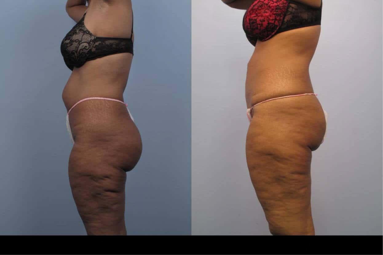Before and after image of cellulite reduction treatment in Toronto showing smoother skin and diminished cellulite on the outer thighs.