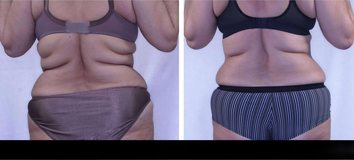 Photo 9 of a Patient Before and After Non-Surgical Body Contouring in Toronto.