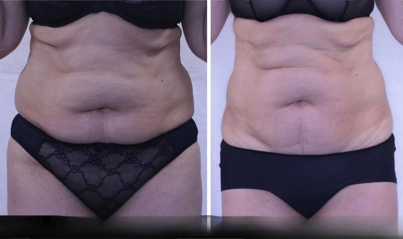 Photo 9 of a Patient Before and After Non-Surgical Liposuction in Toronto.
