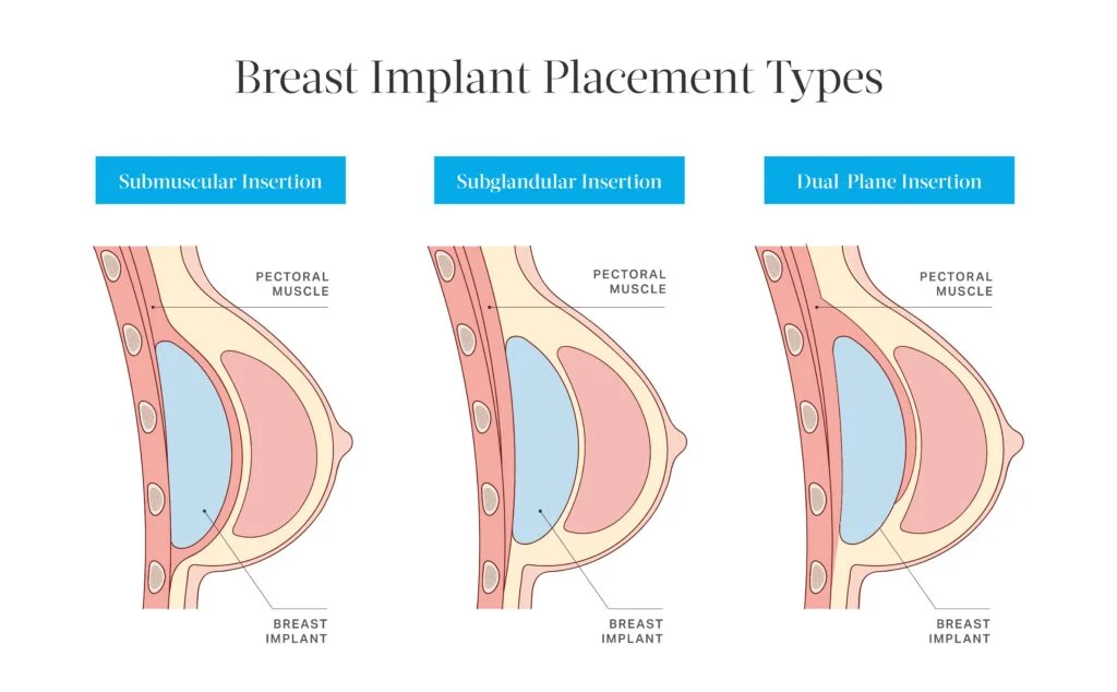 Diagram showing three types of breast implant placements: submuscular insertion (under the pectoral muscle), subglandular insertion (above the muscle), and dual-plane insertion (partially under the muscle).