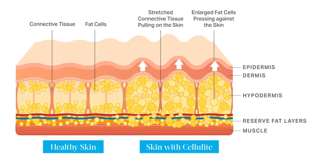 Comparison of healthy skin vs. skin with cellulite, showing connective tissue, fat cells, and skin layers with labels.
