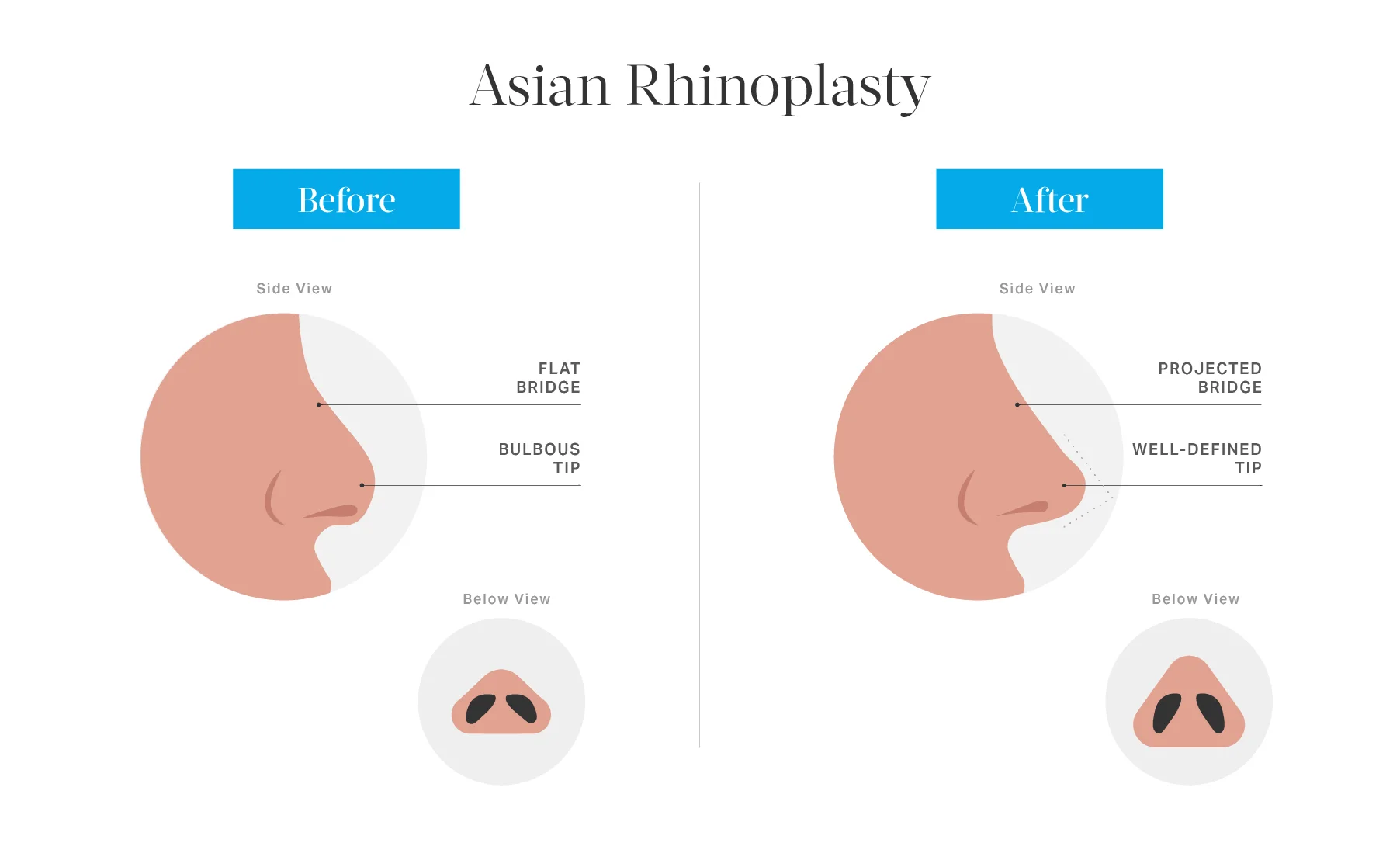 Asian Rhinoplasty in Toronto | Toronto Plastic Surgeon Wellness Centre