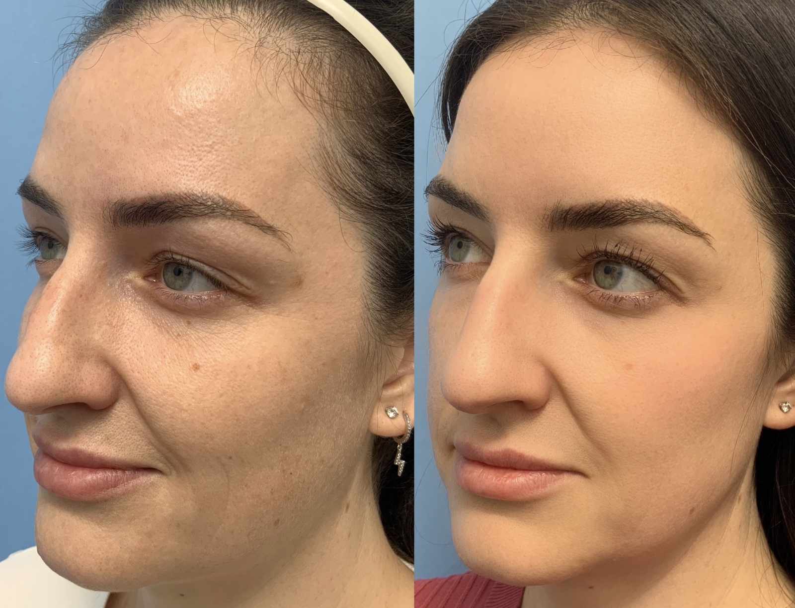 Before and after oblique-view photos of a woman following fractional CO2 laser treatment, showing improved skin texture, reduced pore visibility, and a smoother, more even complexion.