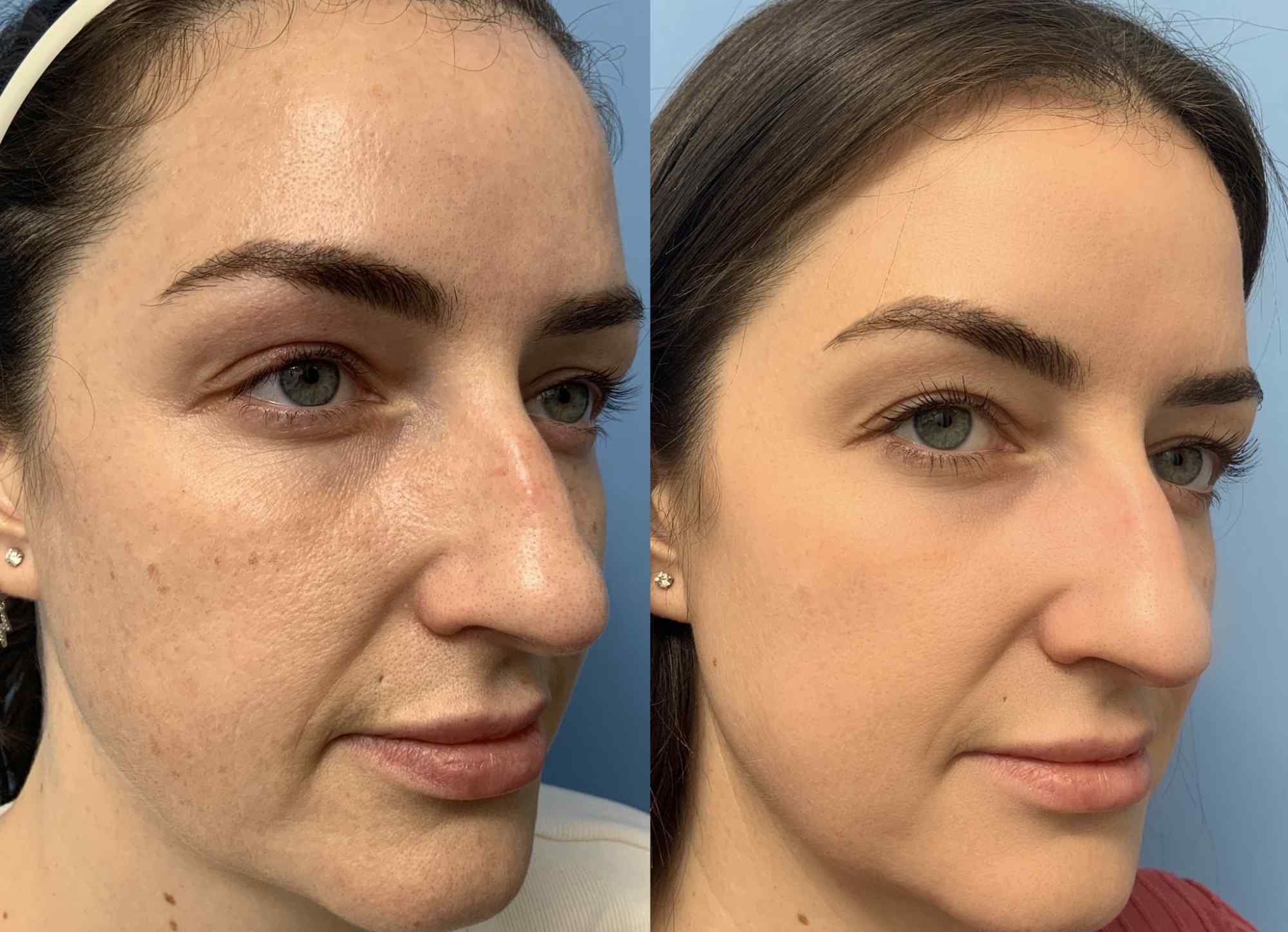 Before and after three-quarter view photos of a woman following fractional CO2 laser treatment, showing reduced sun spots, improved skin texture, and a more even complexion.