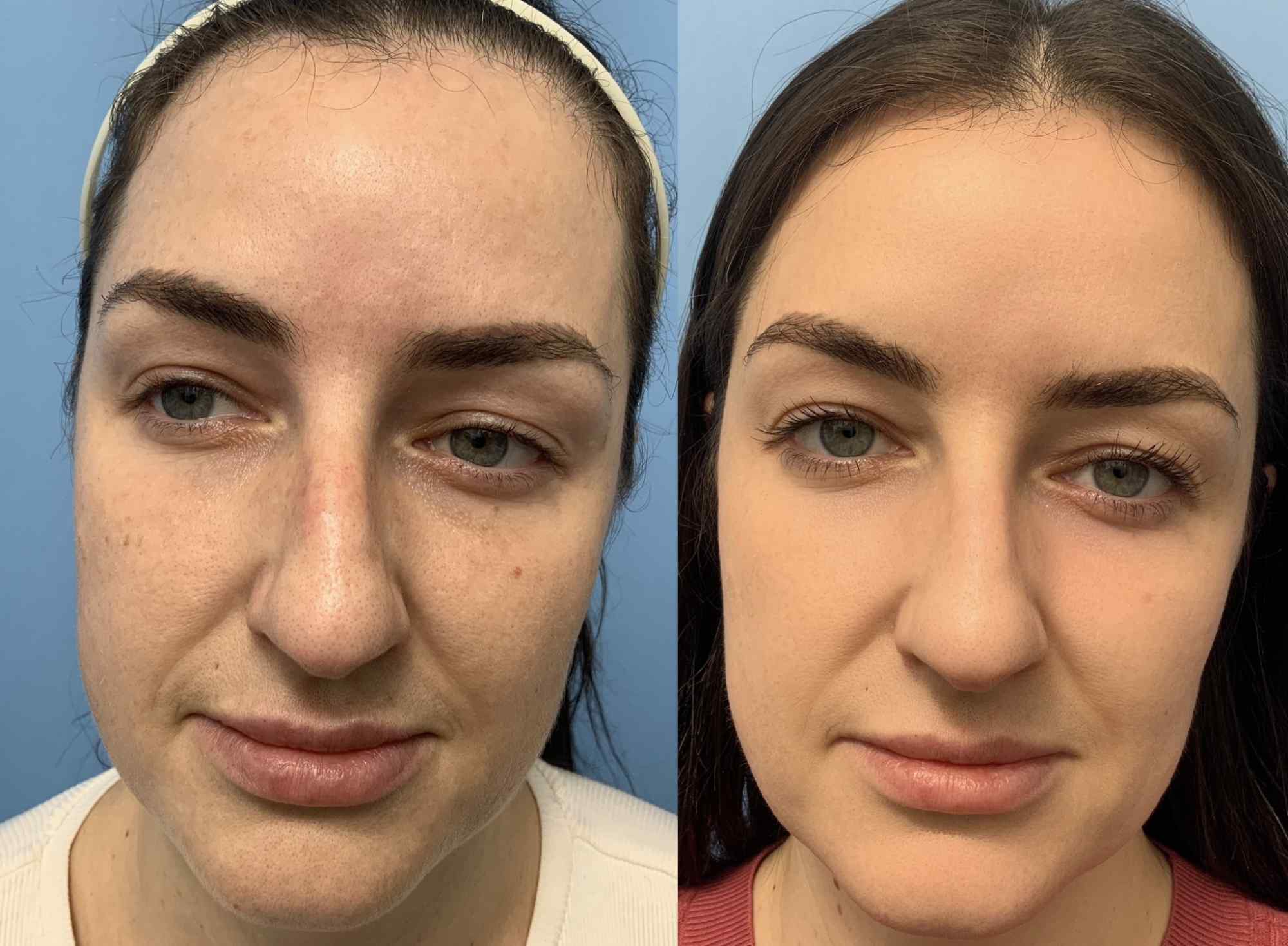 Before and after photos of a woman following fractional CO2 laser treatment. Left image shows the patient with visible skin texture irregularities, redness, and uneven tone. Right image, taken post-treatment, shows noticeably smoother skin texture, reduced redness, more even complexion, and improved overall skin clarity.