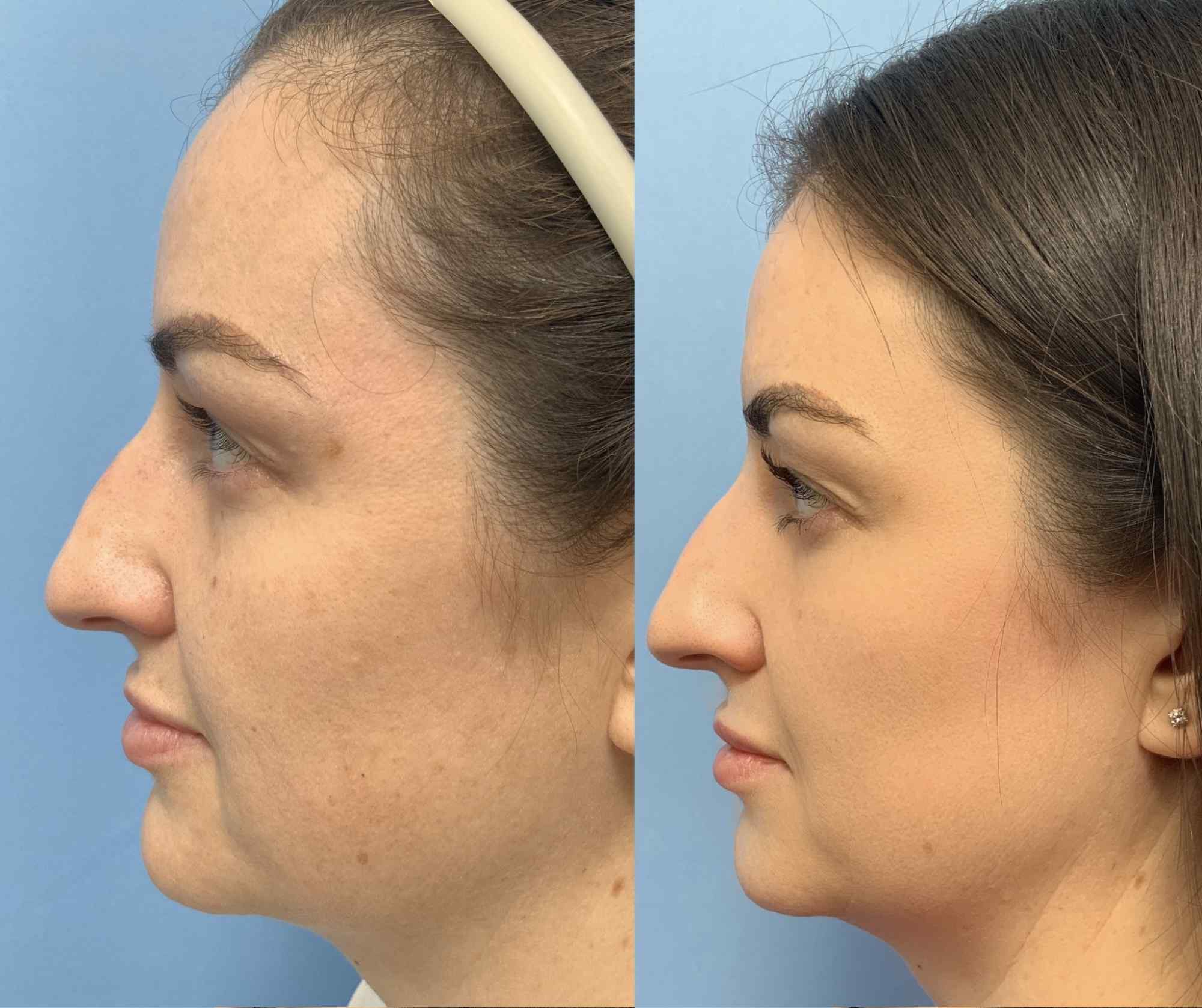 Before and after lateral view photos of a woman following fractional CO2 laser treatment, showing improved skin texture, reduced pores, and a smoother, more refined complexion.