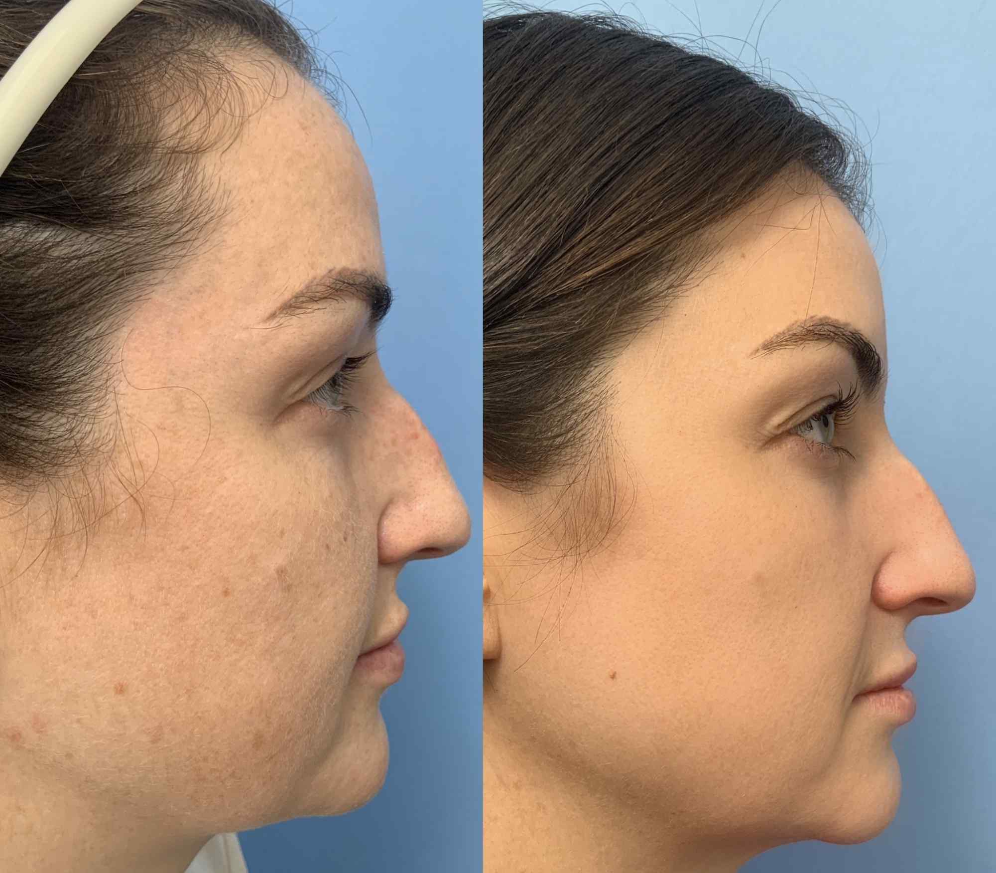 Before and after lateral view photos of a woman following fractional CO2 laser treatment, showing reduced hyperpigmentation, sun spots, and improved skin texture across the cheek and temple.