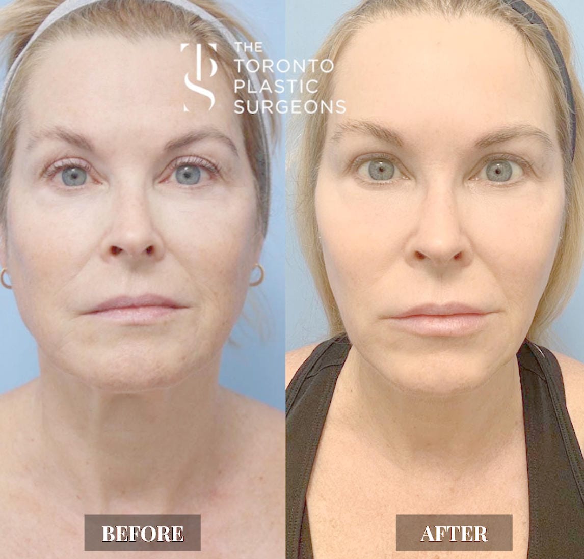 Front-view before and after comparison of a female patient at The Toronto Plastic Surgeons showing firmer, smoother skin with reduced sagging around the cheeks, jawline, and neck.