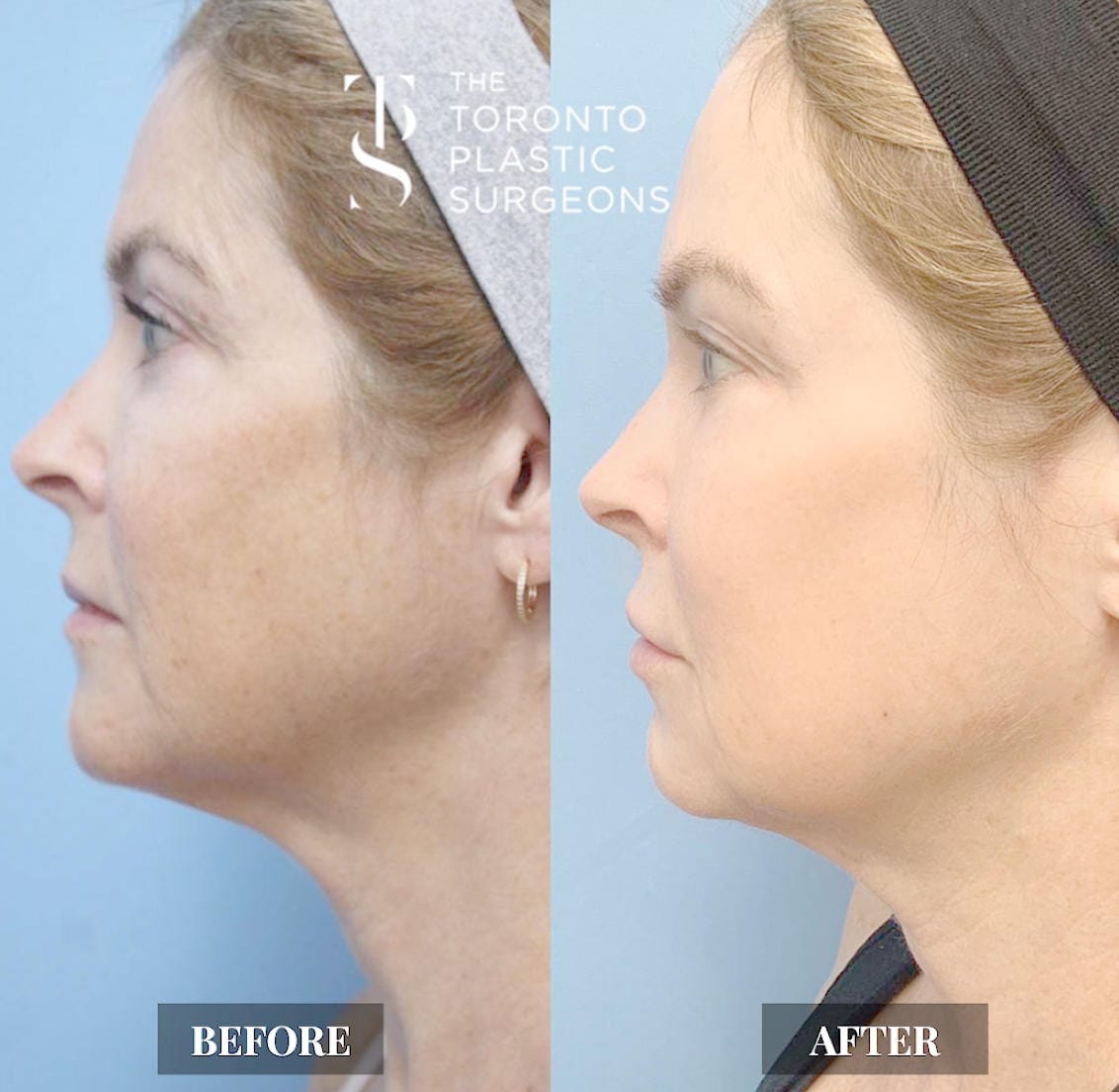 Left profile before and after comparison of a female patient at The Toronto Plastic Surgeons showing improved jawline and neck definition with tighter skin and reduced laxity under the chin after Forma treatment.