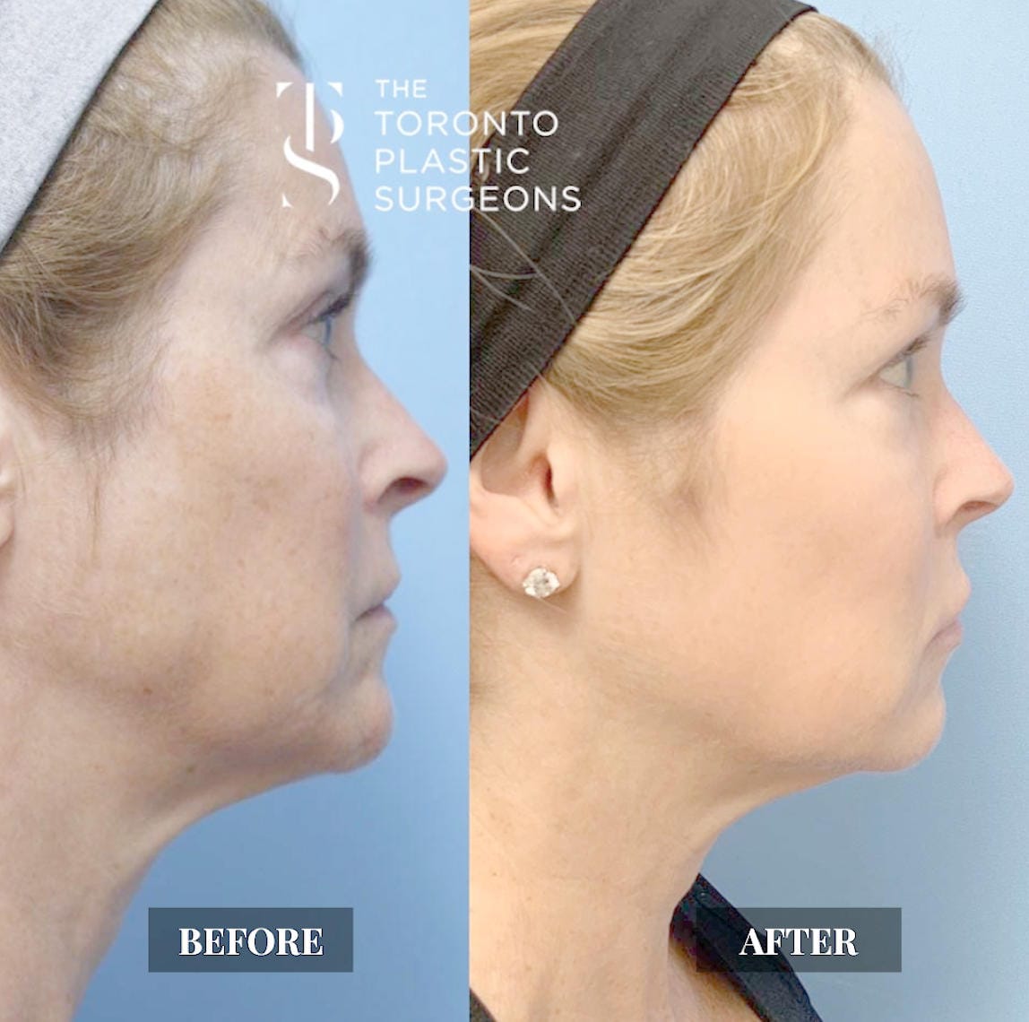 Right profile before and after comparison of a female patient at The Toronto Plastic Surgeons showing a firmer jawline and neck contour with reduced skin laxity and smoother texture along the lower face after Forma treatment.