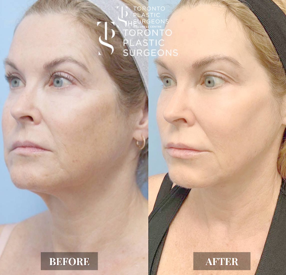 Left three-quarter view before and after comparison of a female patient at The Toronto Plastic Surgeons showing tighter skin along the jawline and cheek with reduced laxity and a more defined lower face after Forma treatment.