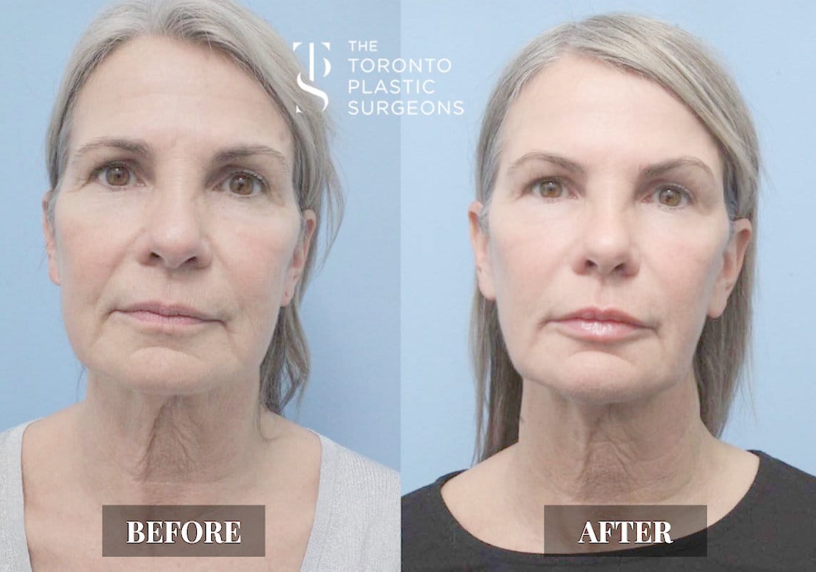 Front-view before and after comparison of a female patient who received Forma skin tightening treatment at The Toronto Plastic Surgeons, showing firmer skin with reduced sagging around the jawline and smoother, tighter contour across the neck.
