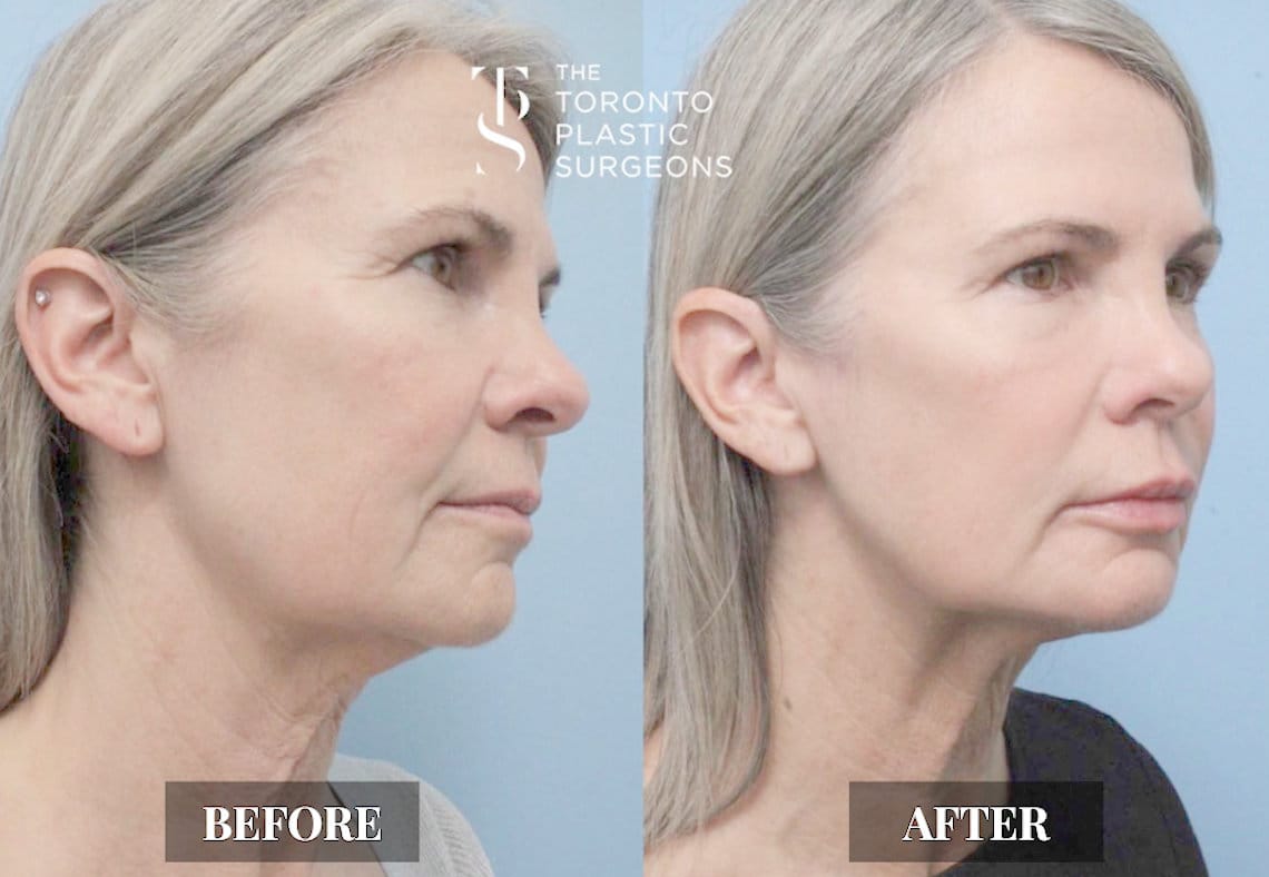 Left three-quarter view before and after comparison of a female patient who received Forma skin tightening treatment at The Toronto Plastic Surgeons, showing improved jawline definition with reduced laxity and tighter skin along the lower face and neck.