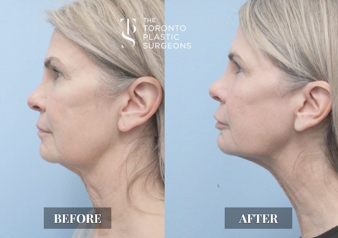 Left profile before and after comparison of a female patient who received Forma skin tightening treatment at The Toronto Plastic Surgeons, showing a firmer jaw and neck contour with reduced sagging and smoother skin under the chin.