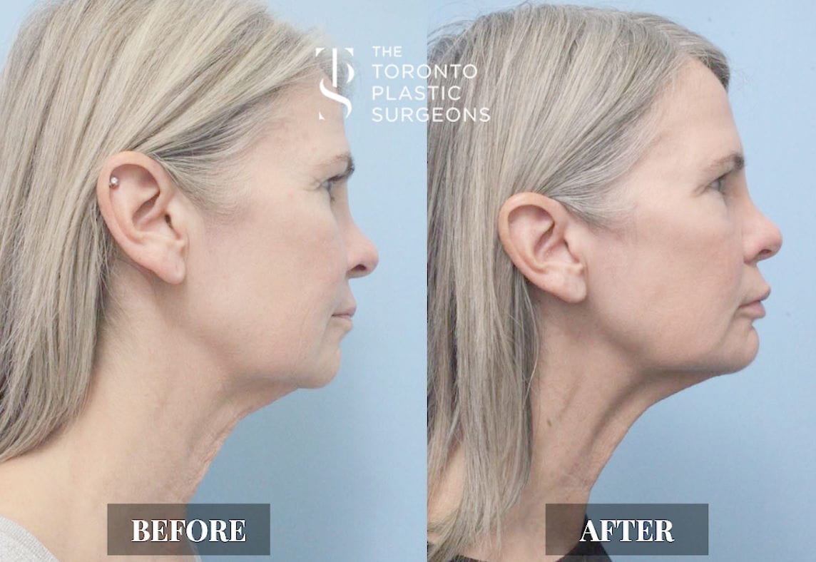 Right profile before and after comparison of a female patient who received Forma skin tightening treatment at The Toronto Plastic Surgeons, showing tighter skin along the jaw and neck with reduced laxity and a more defined lower facial contour.